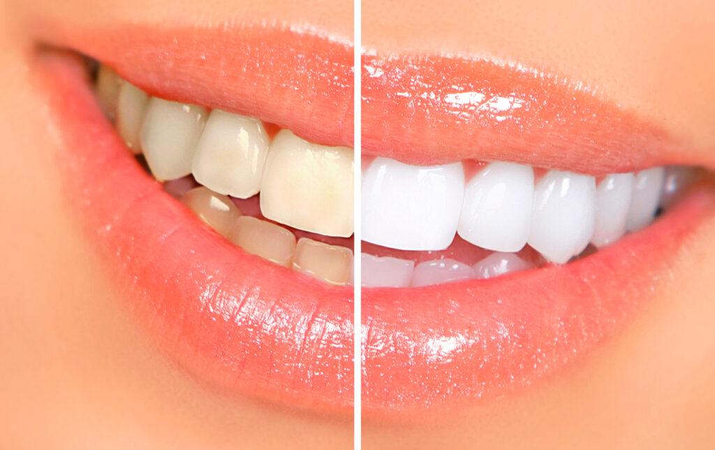 Bleaching Whitening of Your Teeth