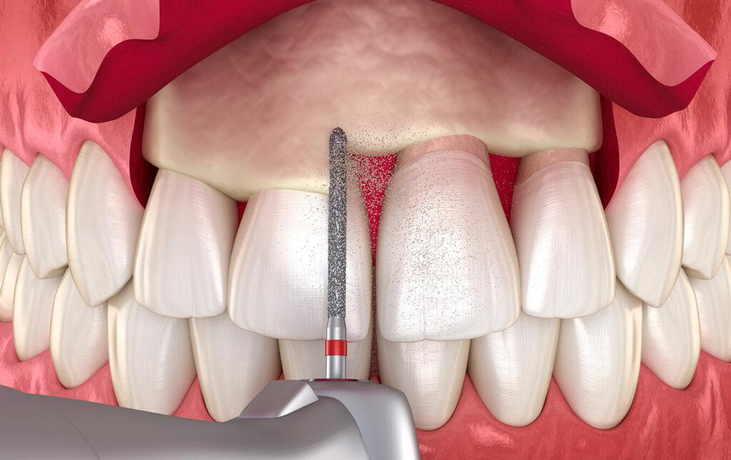 Crown-Lengthening