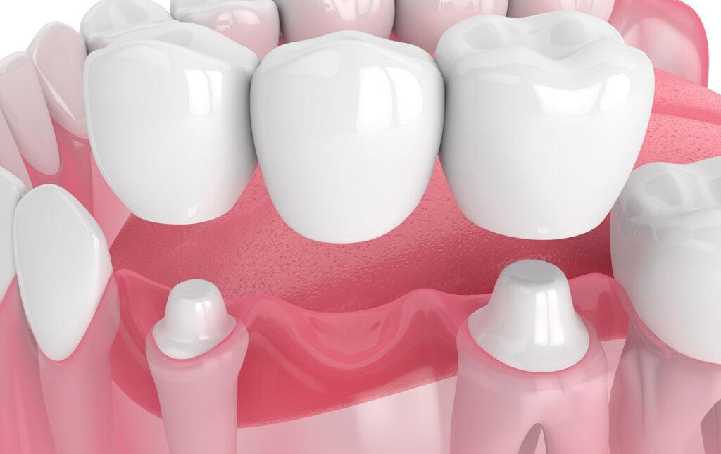 Dental-Bridges-Filling-In-The-Gaps