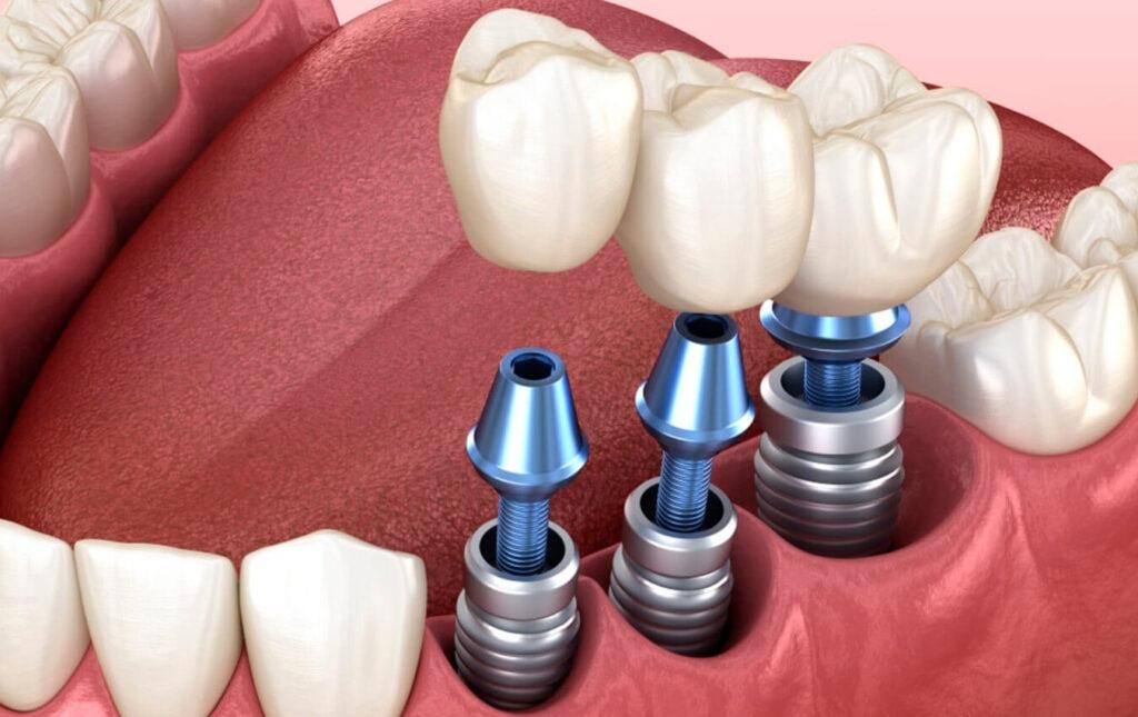 Dental Implants … High Cost, High Value?