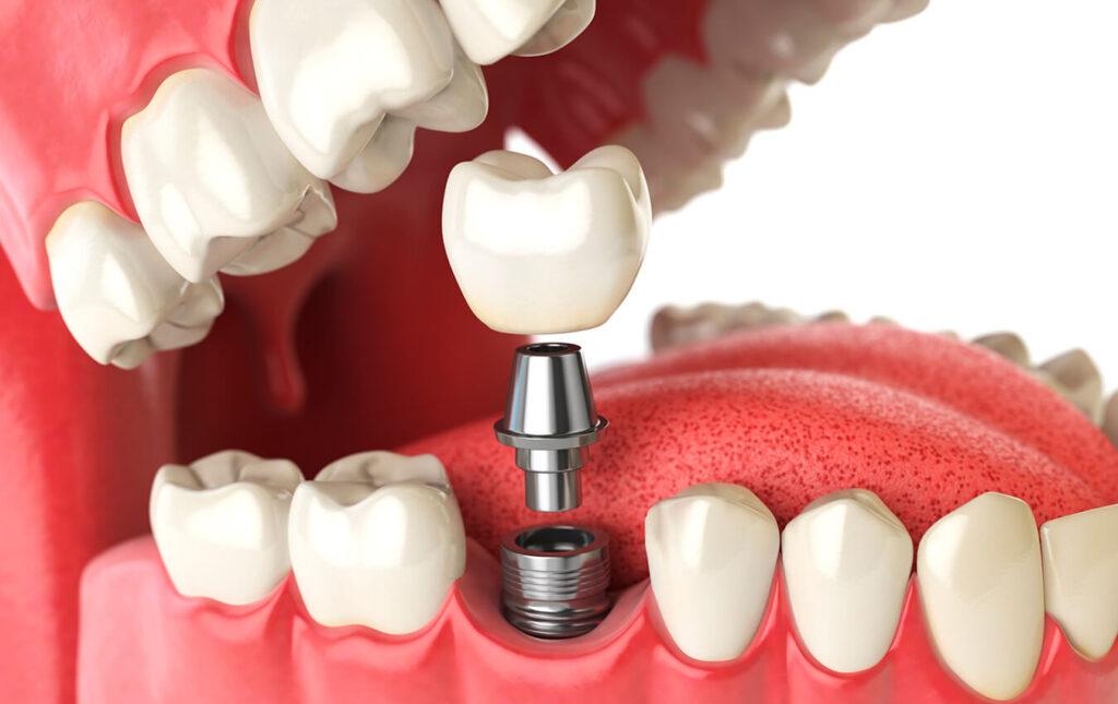 Dental Implants