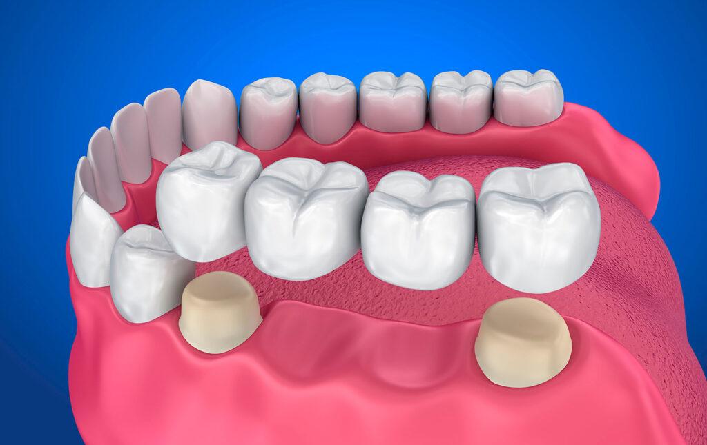 Fixed-Partial-Denture