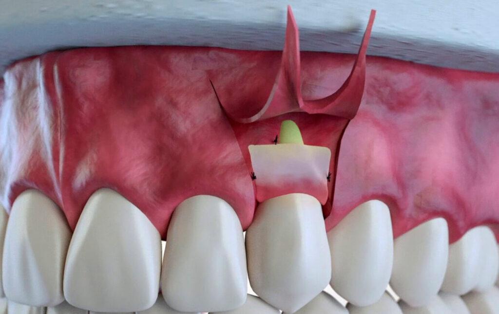 Gingival-Flap-Surgery