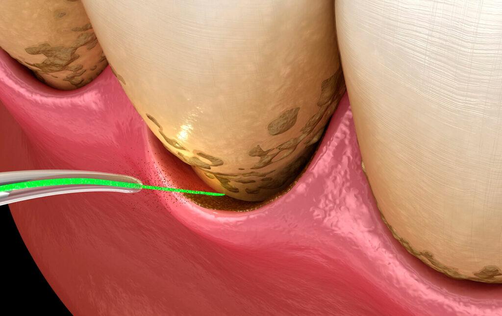 Gum Disease Treatment Without Surgery