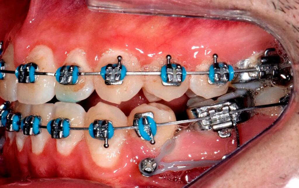 Molar Uprighting