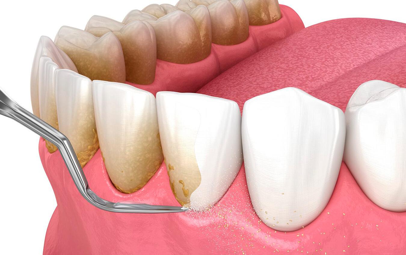 Scaling and Root Planning Aashu Dental