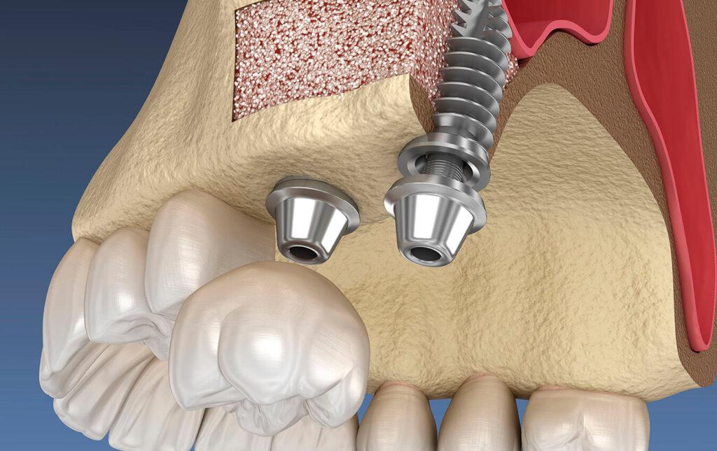 Sinus-Lift