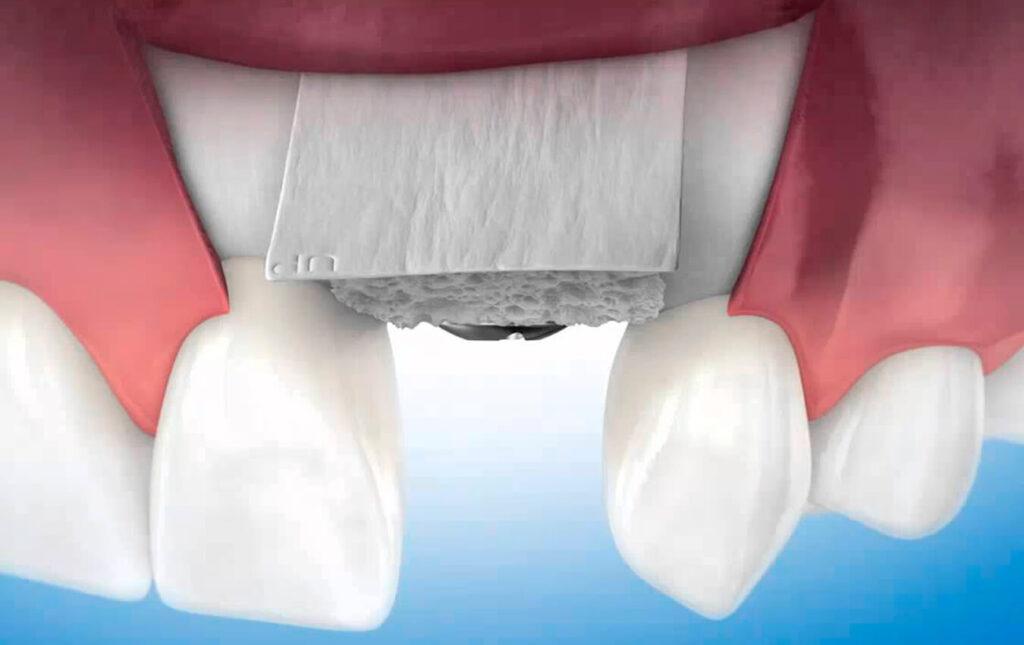 Soft Tissue Graft