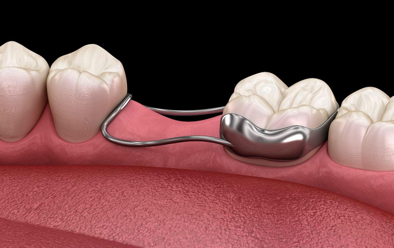 Space Maintainers for Premature Tooth Loss