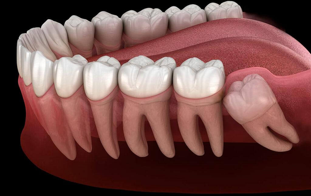 The-Wisdom-Tooth