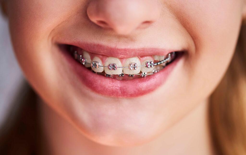 Tips-To-Stay-Cavity-Free-While-Wearing-Braces