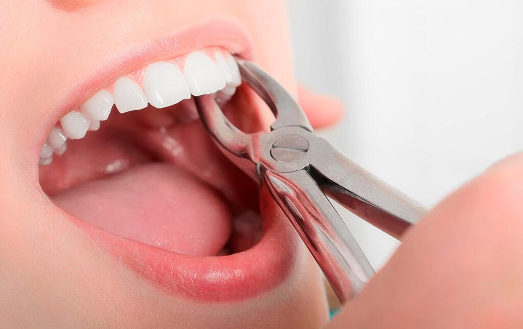 Tooth Extraction