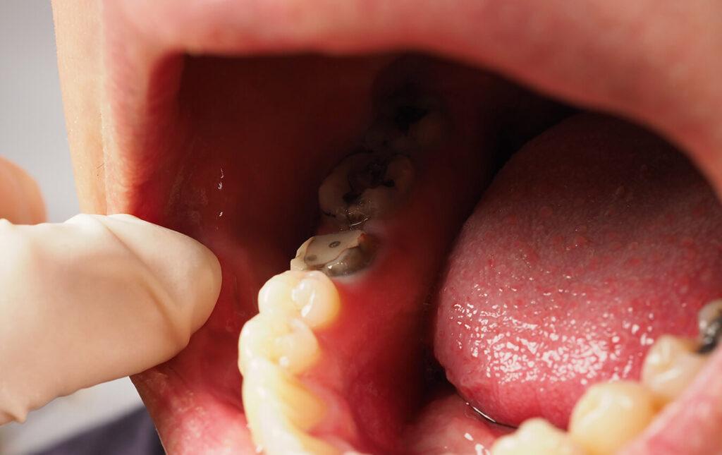 Tuberosity-Reduction