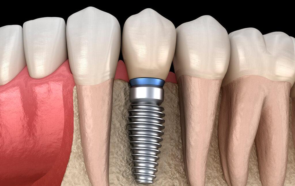 Types of Dental Implants