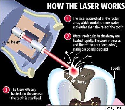 Hard Tissue (Tooth) Laser Dentistry Procedures