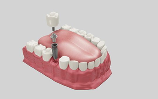 Best Dental Implants Clinic in Ahmedabad