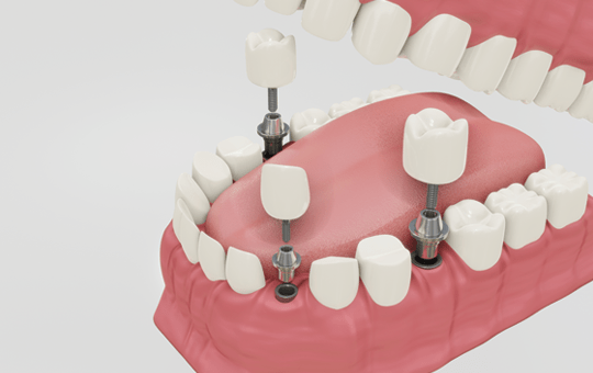 What should you know about dental implants and their placement?