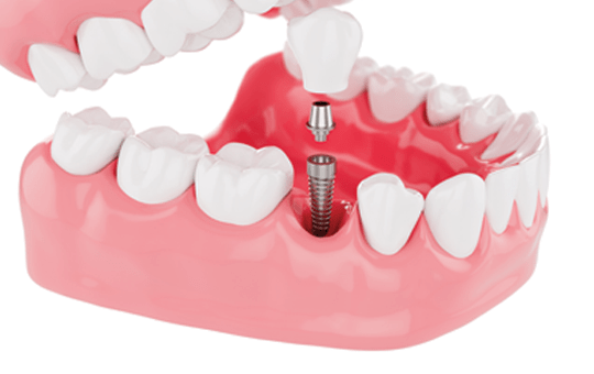 Types of Dental Implant